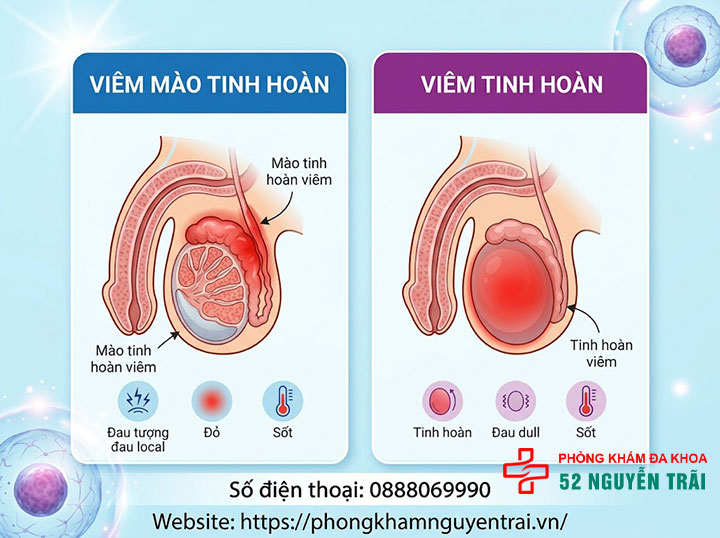 Đau Tinh Hoàn Bên Phải: Nguyên Nhân & Cách Điều Trị 3 Viêm mào tinh hoàn và viêm tinh hoàn