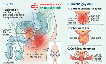 Đau tuyến tiền liệt là bệnh gì? Nguyên nhân, cách xử lý