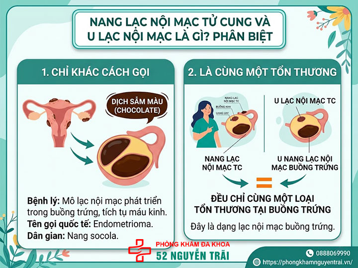 Lạc Nội Mạc Tử Cung Là Gì? Nguyên Nhân, Phân Loại 6 Nang lạc nội mạc tử cung và u lạc nội mạc là gì? Phân biệt