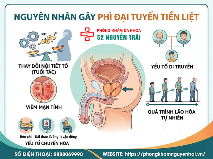 Phì đại tuyến tiền liệt là gì? Nguyên nhân, triệu chứng 5 Nguyên nhân gây phì đại tuyến tiền liệt