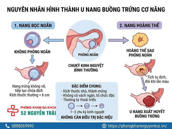 U nang buồng trứng là gì? Nguyên nhân, dấu hiệu, điều trị 6 Nguyên nhân hình thành u nang buồng trứng