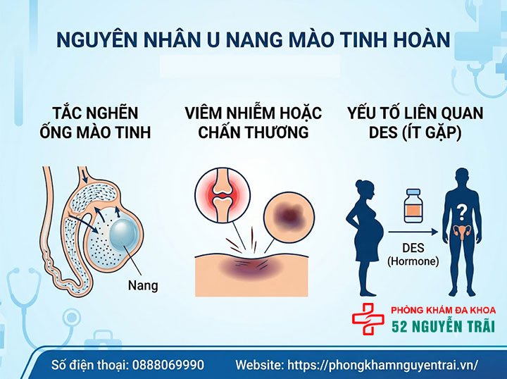U Nang Tinh Hoàn Là Gì? Nguyên Nhân Và Cách Điều Trị 2 Nguyên nhân u nang tinh hoàn