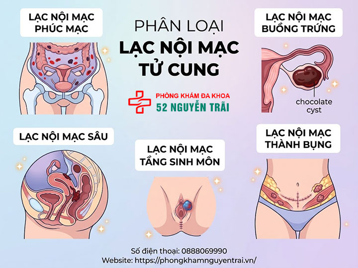 Lạc Nội Mạc Tử Cung Là Gì? Nguyên Nhân, Phân Loại 3 Phân loại lạc nội mạc tử cung: phúc mạc, buồng trứng, sâu, thành bụng, tầng sinh môn