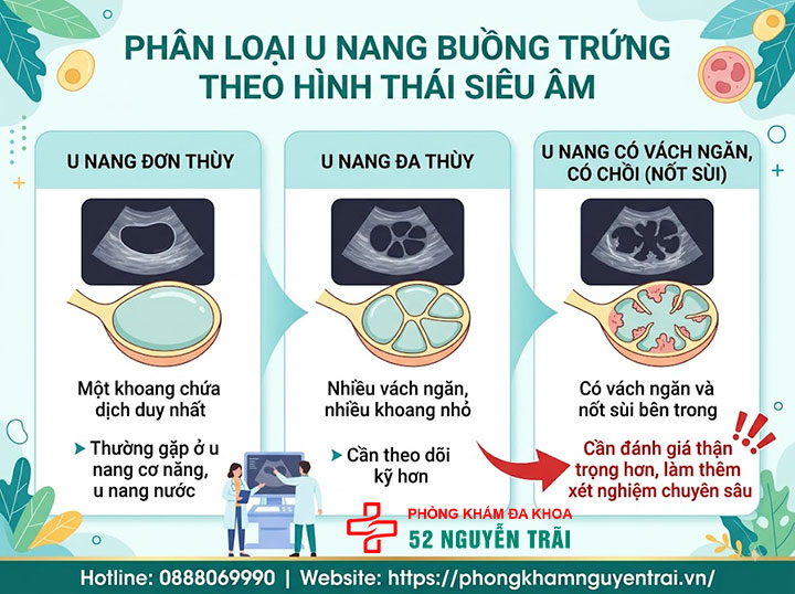 U nang buồng trứng là gì? Nguyên nhân, dấu hiệu, điều trị 4 Phân loại u nang buồng trứng theo hình thái trên siêu âm