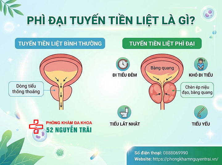 Phì đại tuyến tiền liệt là gì? Nguyên nhân, triệu chứng 1 Phì đại tuyến tiền liệt là gì?