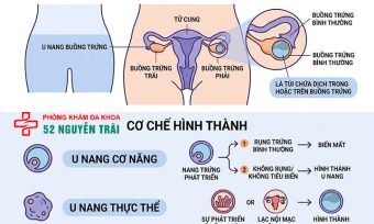 U nang buồng trứng là gì? Nguyên nhân, dấu hiệu, điều trị
