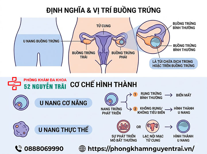 U nang buồng trứng là gì? Nguyên nhân, dấu hiệu, điều trị 1 U nang buồng trứng là gì?