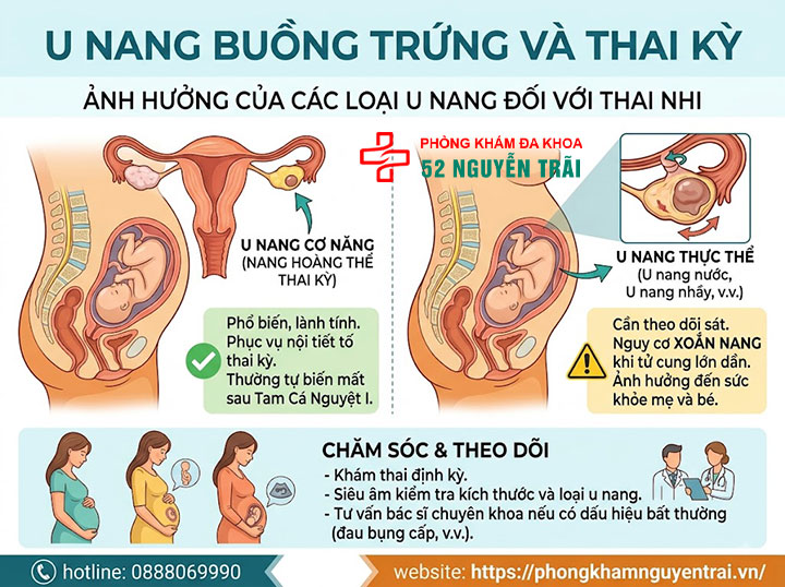 U nang buồng trứng là gì? Nguyên nhân, dấu hiệu, điều trị 9 U nang buồng trứng và thai kỳ