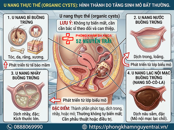 U nang buồng trứng là gì? Nguyên nhân, dấu hiệu, điều trị 3 U nang thực thể (organic cysts)