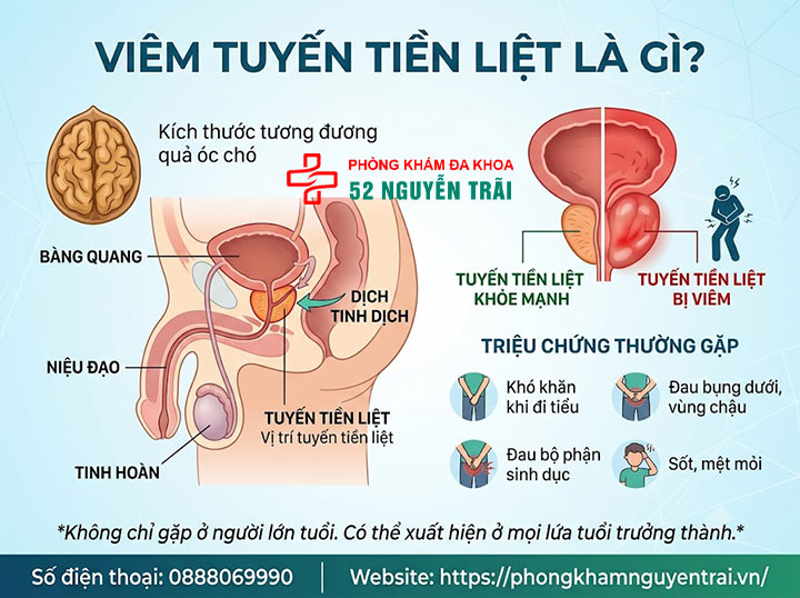 Viêm tuyến tiền liệt là gì? Phân loại và nguy cơ mắc bệnh 1 Viêm tuyến tiền liệt là gì?