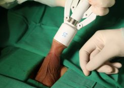 Bác sĩ chỉ ra 5++ triệu chứng của dài bao quy đầu ở nam giới