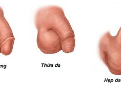 Dài bao quy đầu không cắt có sao không?