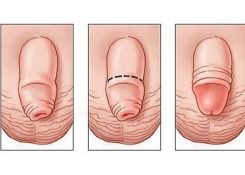 Top 3 + Biểu hiện dài bao quy đầu dễ nhận biết nhất | Phương pháp điều trị