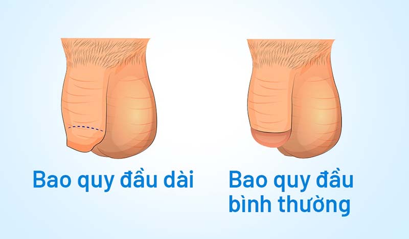 Dài bao quy đầu là gì?