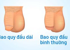 5++ Dấu hiệu nhận biết dài bao quy đầu ở nam giới? Cách điều trị như thế nào?