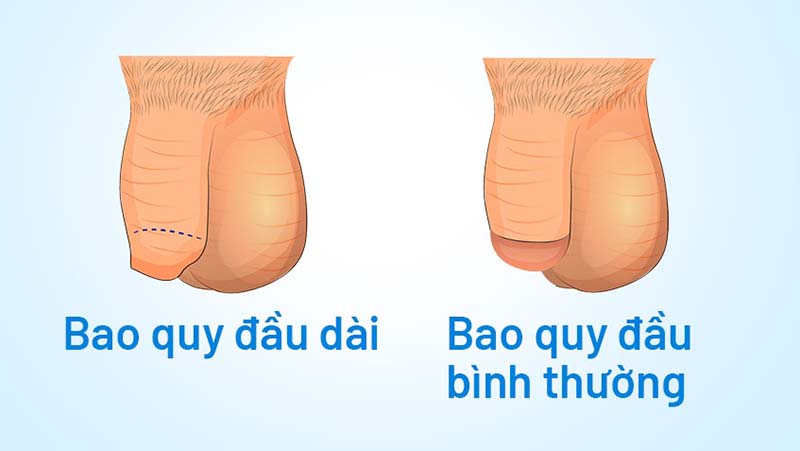 Nguyên nhân phổ biến gây ra tình trạng bao quy đầu dài giả