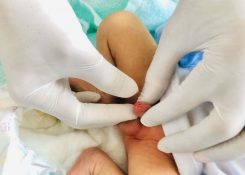 Bệnh hẹp bao quy đầu ở trẻ? Cách điều trị hiệu quả