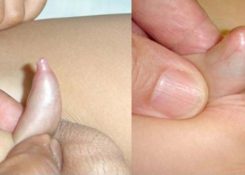 Hẹp bao quy đầu ở trẻ khi nào cần can thiệp