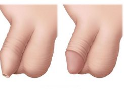 Top 3++ Nguyên nhân hàng đầu gây ra tình trạng dài bao quy đầu