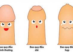 Chi phí phẫu thuật dài bao quy đầu bao nhiêu tiền