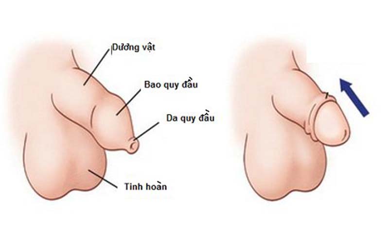 Cách điều trị bán hẹp bao quy đầu hiệu quả