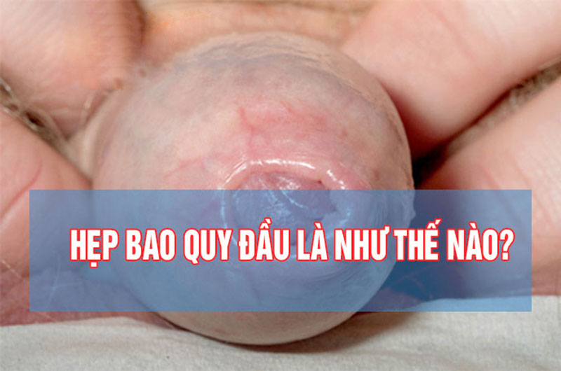 Hẹp bao quy đầu là gì?