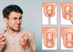4 cách chữa hẹp bao quy đầu mang lại hiệu quả tốt nhất