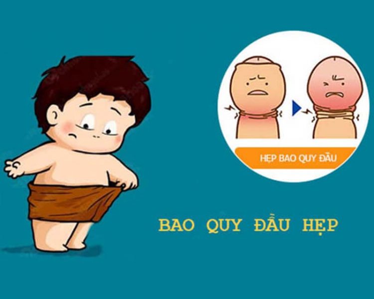 Hẹp bao quy đầu là gì? 