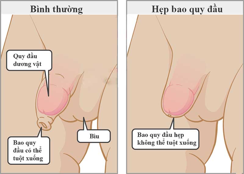 Dấu hiệu nhận biết hẹp bao quy đầu