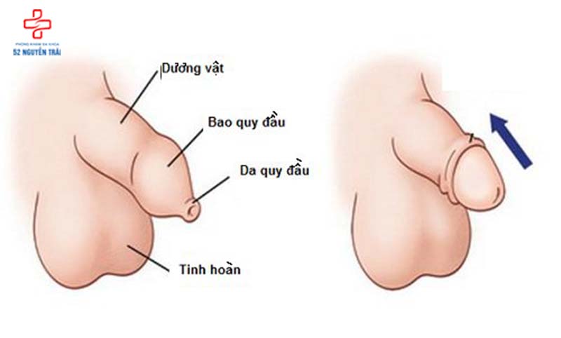 hẹp bao quy đầu ở trẻ 9 tuổi