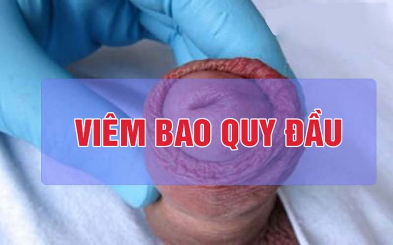 Hẹp bao quy đầu và mọc mụn là triệu chứng viêm bao quy đầu 