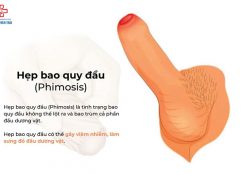 Một số hình ảnh hẹp bao quy đầu trong thực tế