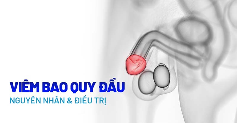 Nguyên nhân gây viêm bao quy đầu