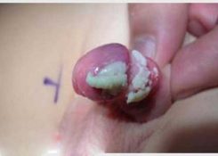 Bao quy đầu có cặn trắng mùi hôi có nguy hiểm không?