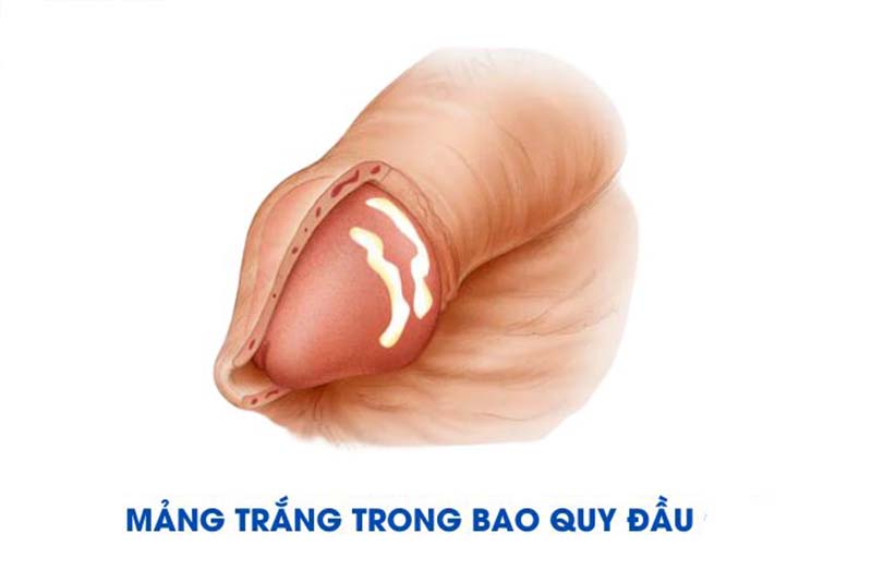 Nguyên nhân gây ra cặn trắng ở vùng bao quy đầu 