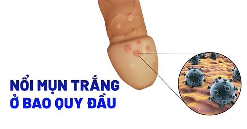 5 Nguyên nhân nổi mụn trắng ở bao quy đầu 