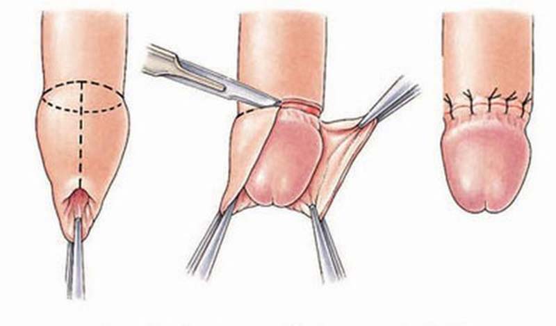 Đối với bệnh viêm bao quy đầu, dài/hẹp bao quy đầu