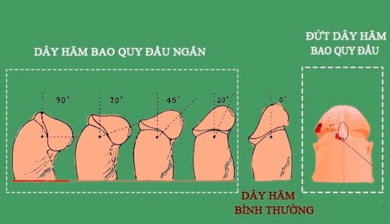 Đứt dây hãm bao quy đầu