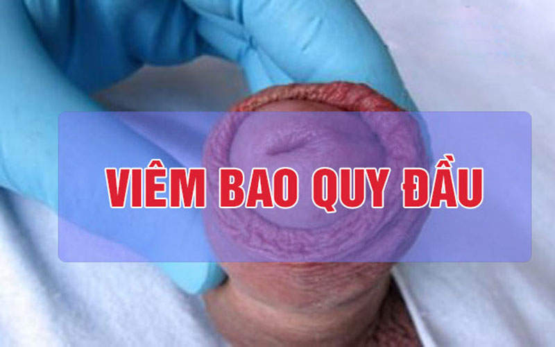 Bao quy đầu mọc mụn do nguyên nhân bệnh lý