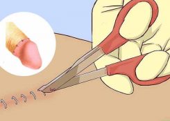 Cắt bao quy đầu bao lâu thì khỏi?