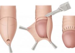 Những ưu điểm của phương pháp cắt bao quy đầu thẩm mỹ