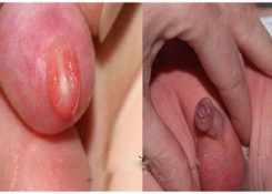 Chất màu vàng trong bao quy đầu là bệnh gì? Có nguy hiểm không