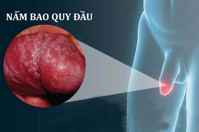 Dấu hiệu nhận biết nấm vùng kín 