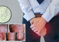 Cách chữa nấm vùng kín ở nam giới hiệu quả tốt nhất
