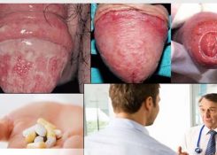 5++ dấu hiệu, triệu chứng nhận biết bệnh nấm bao quy đầu ở nam giới