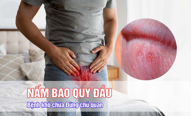 Không điều trị nấm bao quy đầu có sao không?