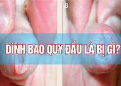 Dính bao quy đầu là gì? Nguyên nhân và cách khắc phục