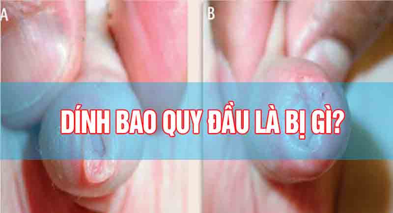 Dính bao quy đầu là gì?