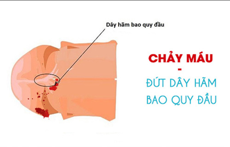 Đứt dây hãm bao quy đầu là gì?