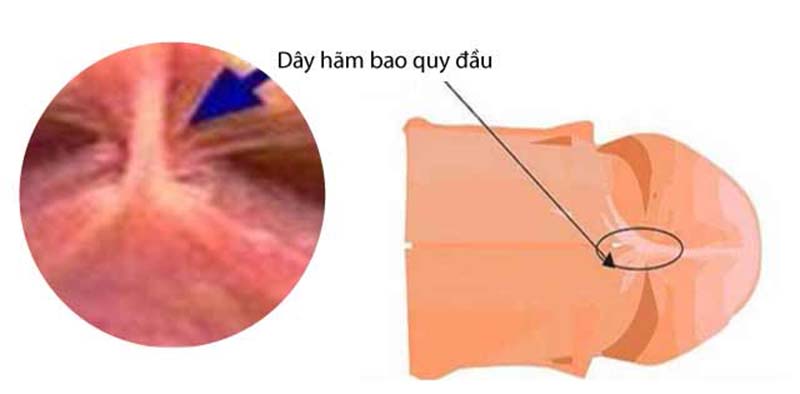 Dây hãm bao quy đầu là gì? có chức năng gì